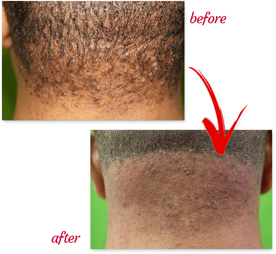 Dr U Acne Keloidalis Nuchae Clinic For The Best Treatments Of Akn Or