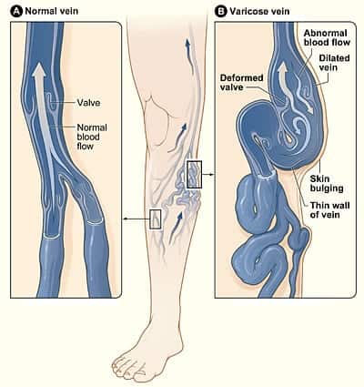 Varicose Vein Treatment in Los Angeles, CA