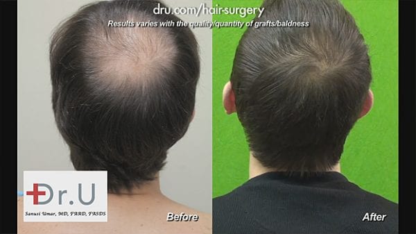 Video - Dr UGraft Crown Hair Transplant Services Los Angeles