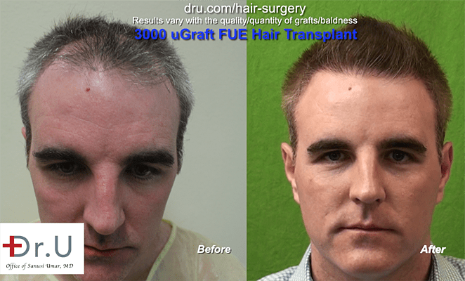 Can I Go Bald After a Hair Transplant  Chicago IL  Chicago Hair  Institute