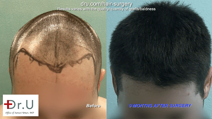 Video - Hair Loss After Hair Transplant at 26 In a Happy Patient