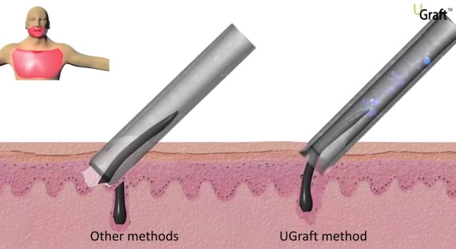 Diagram of basic FUE methods vs. the Dr UGraft method