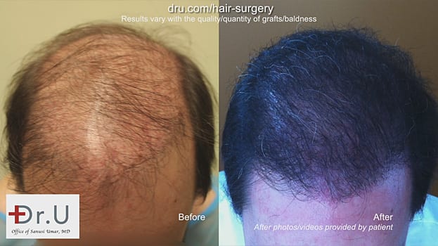 Before and After: strip surgery hair transplant repair with the Dr.UGraft