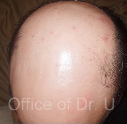 Patient scalp prior to Dr U FUE body hair transplantation