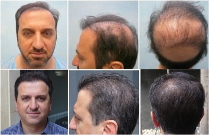 Пересадка волос фото по месяцам