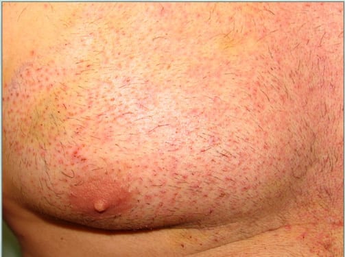 Chest donor area after body hair transplant