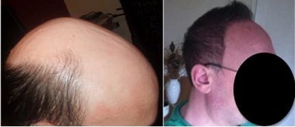 Before and After body hair to head transplant with the Dr.UGraft 