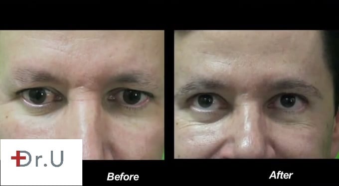 Body hair transplant results: Eyebrow restoration in a male patient