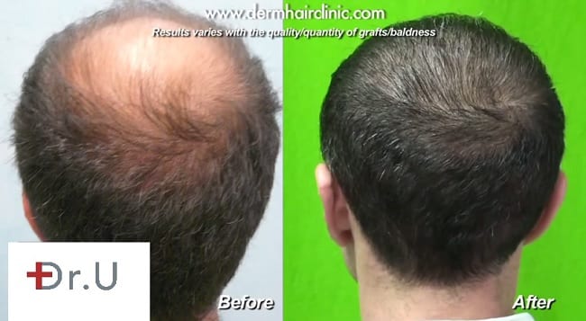Hair Transplant for the Crown: Before or After a Hairline Restoration?