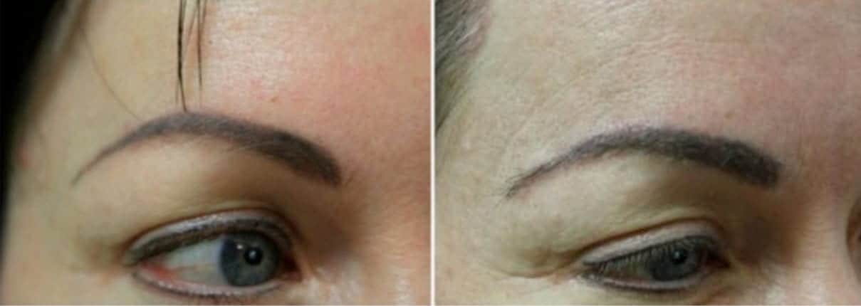 Groundbreaking innovation: eyebrow hair transplant with the DrUGraft