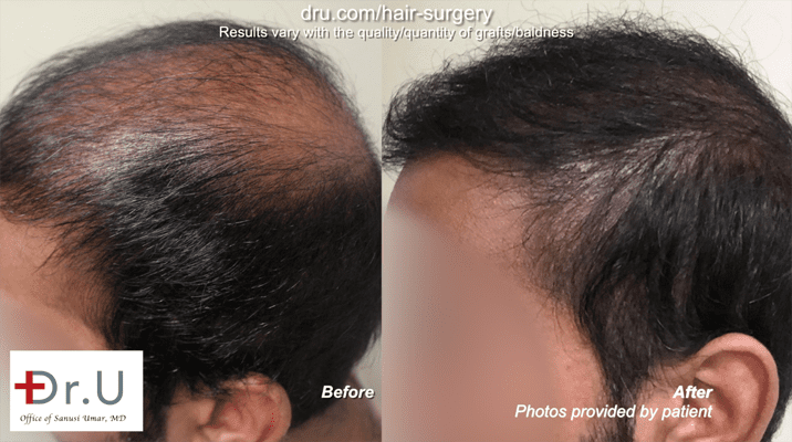 Video - Dr Umar Uses BHT to Fix Hair Transplant Failure