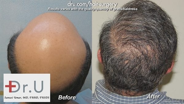 New Body Hair Transplant Study Shows Key To Better Consistency - Dr. U