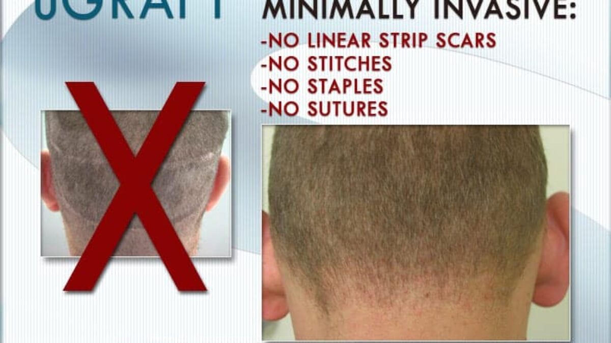 VIDEO Follicular Unit Extraction FUE Hair Transplant Services