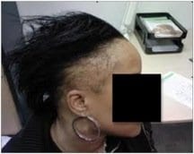 Traction alopecia: a cause of hair loss, prominently in women