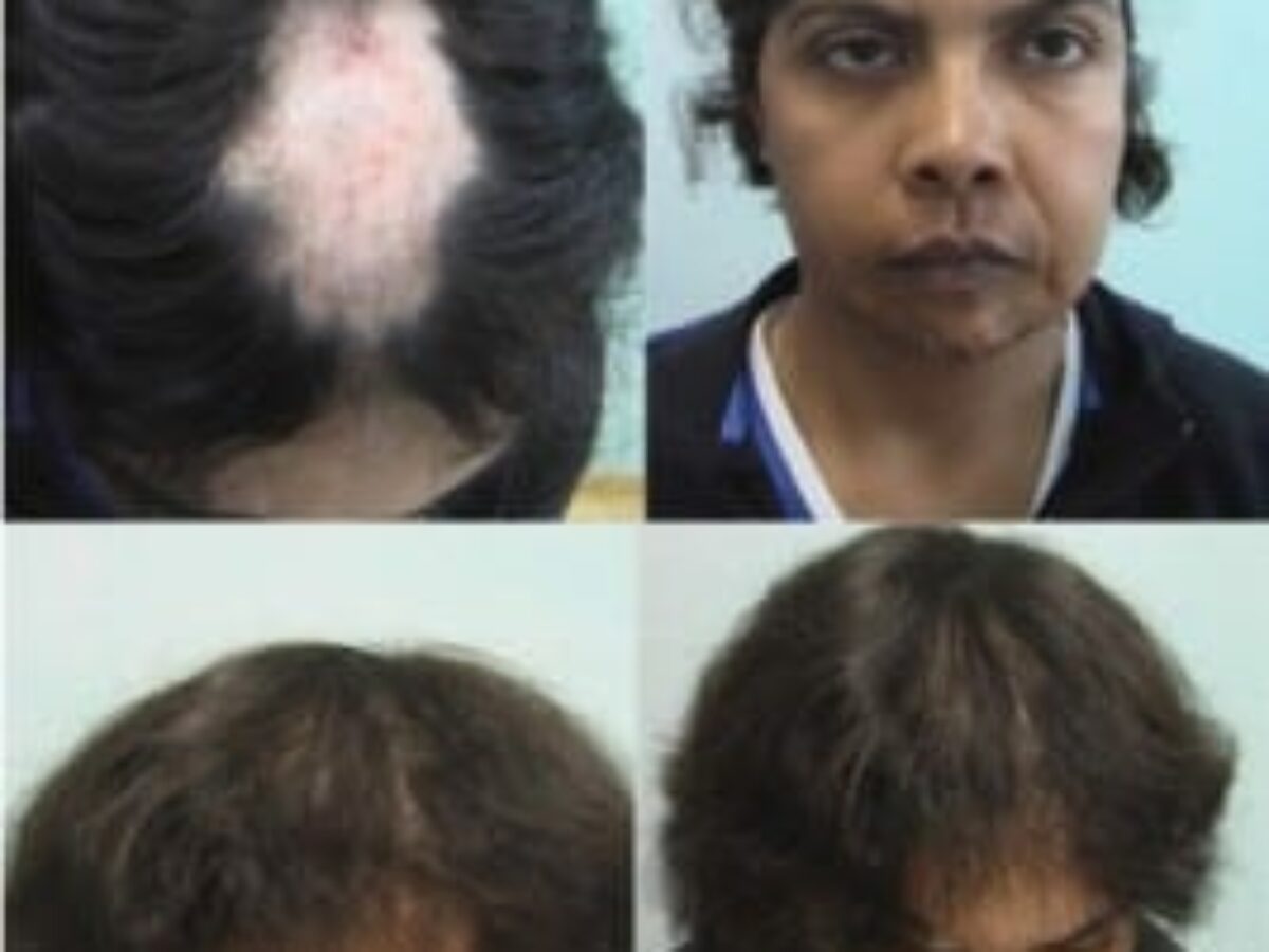 Female Hair Transplantation Procedure in Toronto  SpaMedica