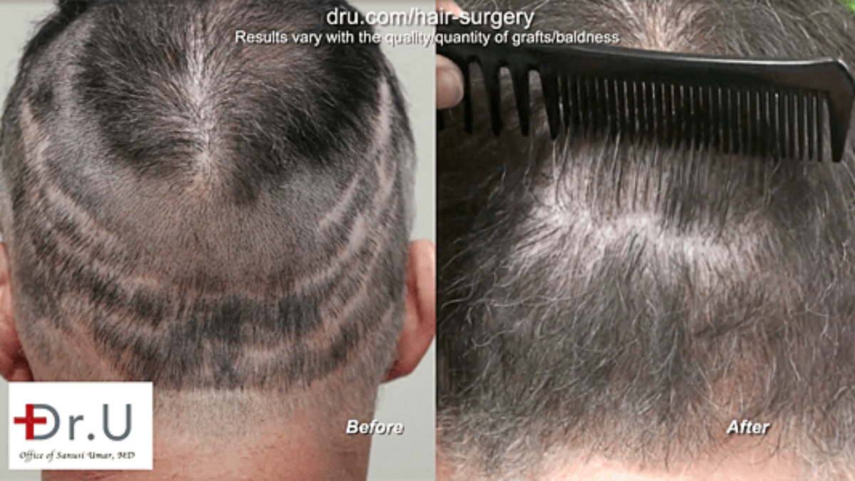 Hair Transplant In Hyderabad, Hair Transplant Cost, Find Best Reviewed  Reviewed Hospitals & Surgeons, Reviews | Practo