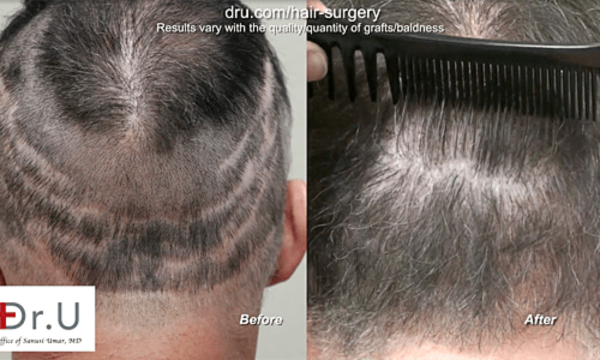 Video - Bad Hair Transplant Repair Services Los Angeles
