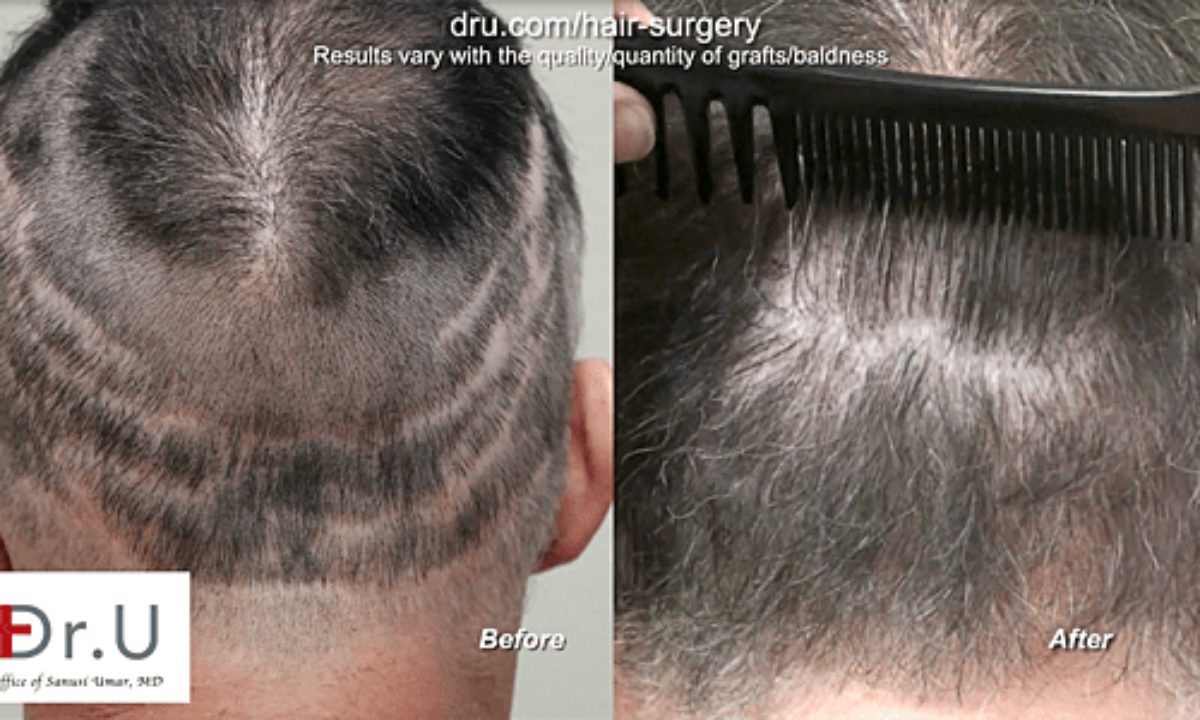 Hair Transplant Articles  Hair Transplant Blogs  Hair Transplant Surgery  Articles Blogs