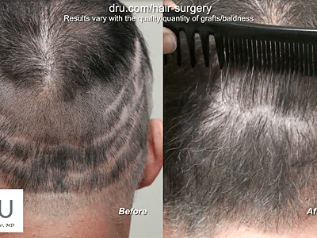 Video - Bad Hair Transplant Repair Services Los Angeles