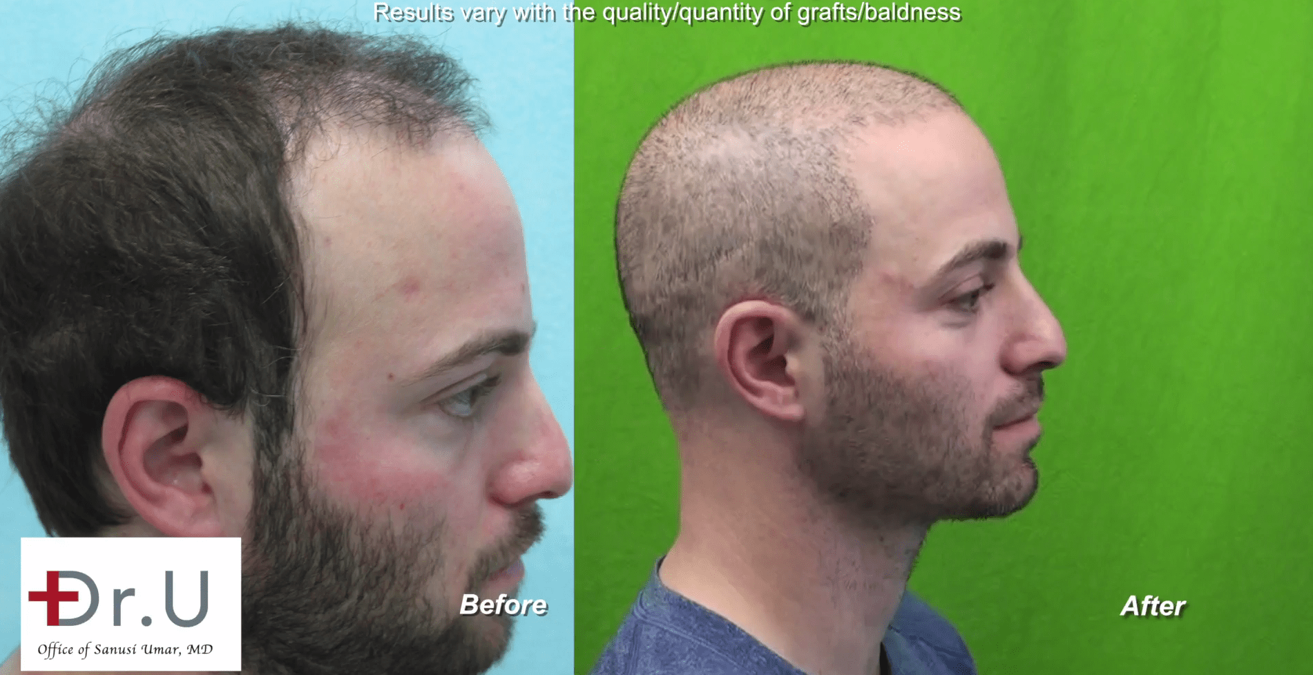 VIDEO: Los Angeles Young Age Hair Transplant Using Dr. UGraft By Dr. U