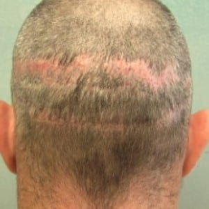 Hair transplant surgery services: Hair transplant surgery scar before treatment by Dr. Umar