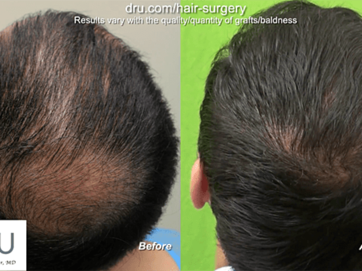 Hair Restoration Surgery and Hair Replacement in Los Angeles
