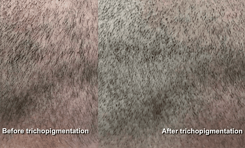 After Trichopigmentation by Dr. Umar it looks like this patient has a thicker head of hair.*