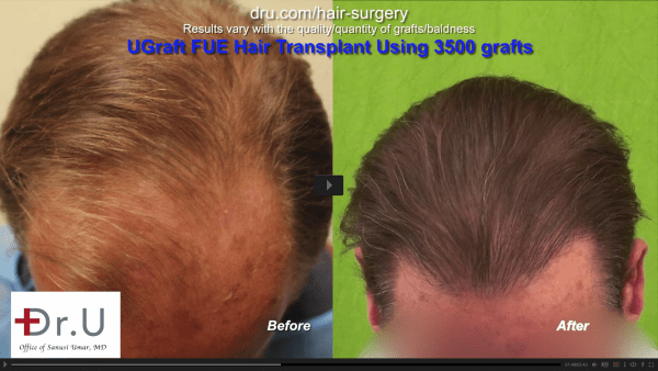 Video: Increased Confidence After Hair Transplant with Dr. U
