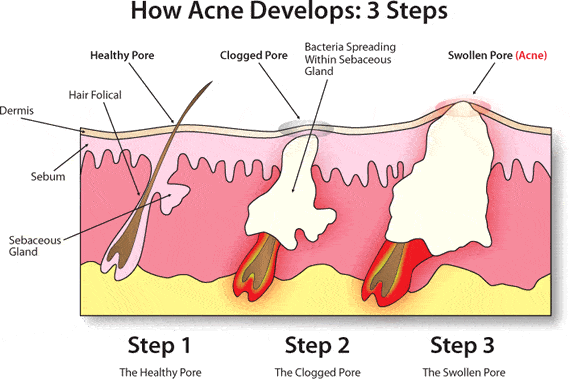 acne vulgaris diagram