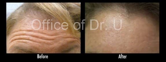 Forehead wrinkles reduced with Botox treatment patient results - Dr. U Skin & Hair Clinic, Los Angeles, CA.