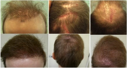 Toupee or hair transplant sale