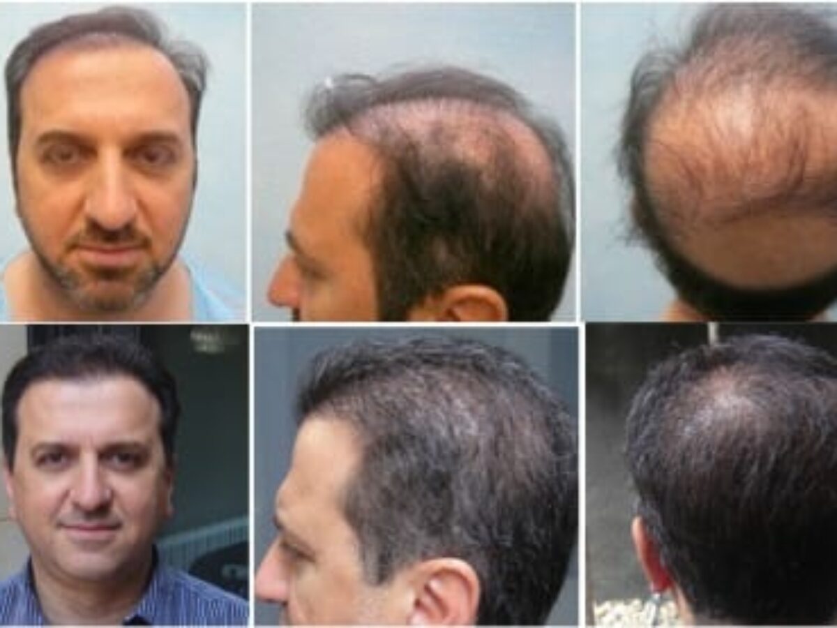 Video - Hair Transplant Cost: How much is a good hair transplant FUE?