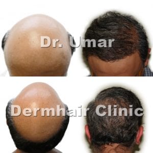 Hair transplantation: Hair transplant surgery for men with Dr.UGraft