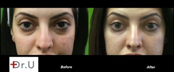 Video: Dark Circles Under Eye Treatment Services Los Angeles