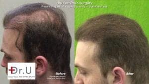 Highly successful strip surgery hair transplant repair using 6500 UGrafts