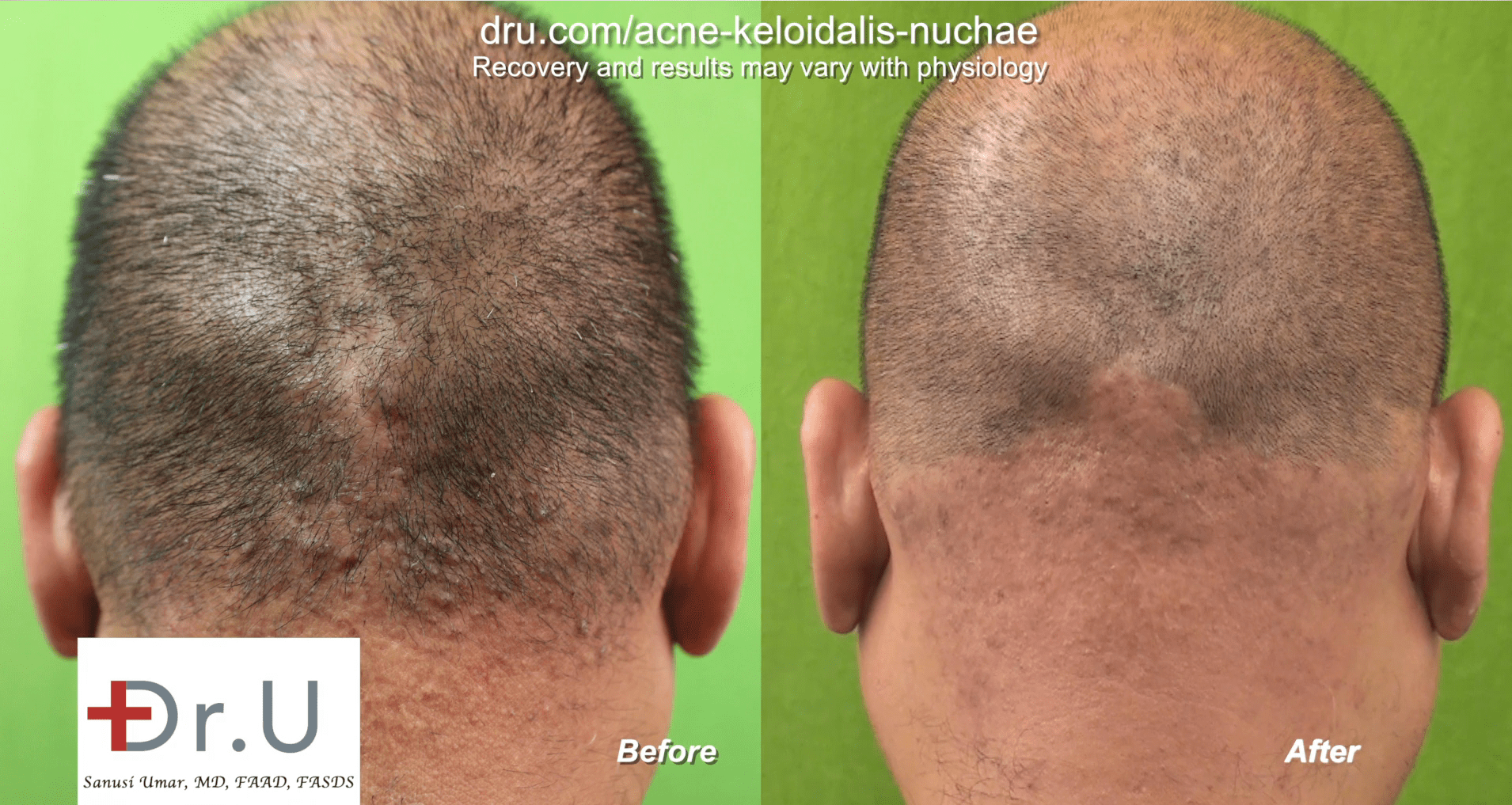 Video Laser Treatment For Bumps On Back Of Head By Dr U