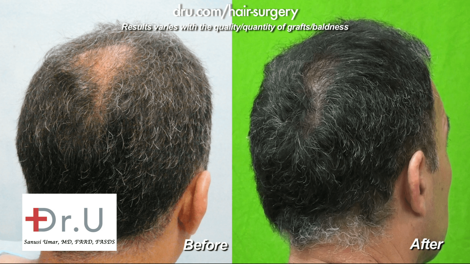 The patient now has considerable coverage on the crown of his head thanks to Dr. Umar and his DrUGraft method.