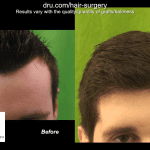 Norwood 1 Forehead Size Reduction hairline transplantation Before an After Norwood 1 Forehead Size Reduction hairline transplantation Before and After
