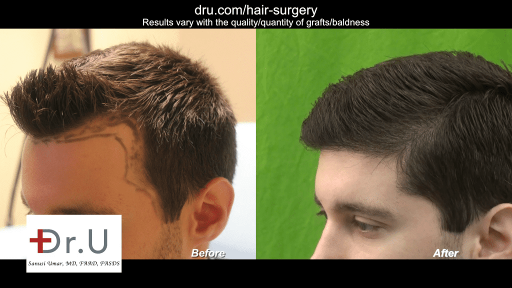 Video - Hair Transplant Cost: How much is a good hair transplant FUE?