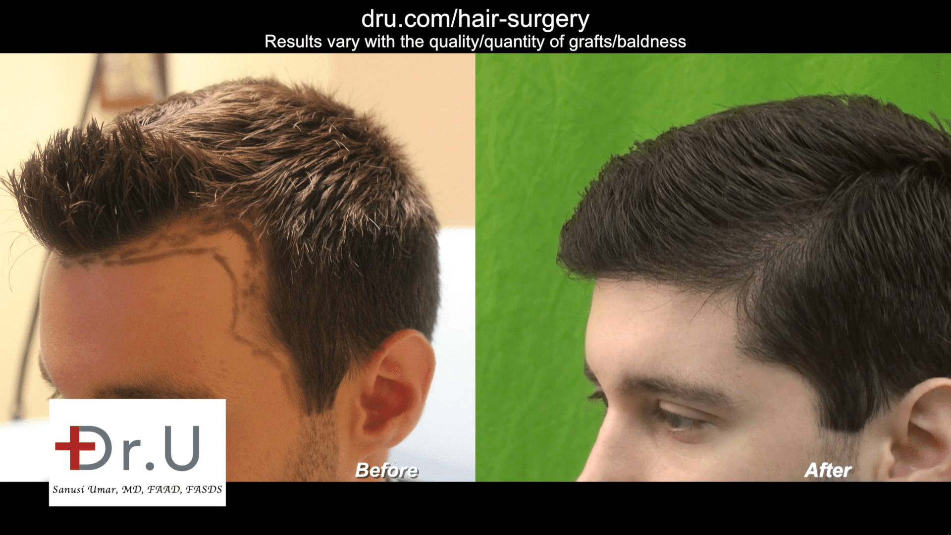 VIDEO: Forehead Reduction Using Hair Transplant with  FUE