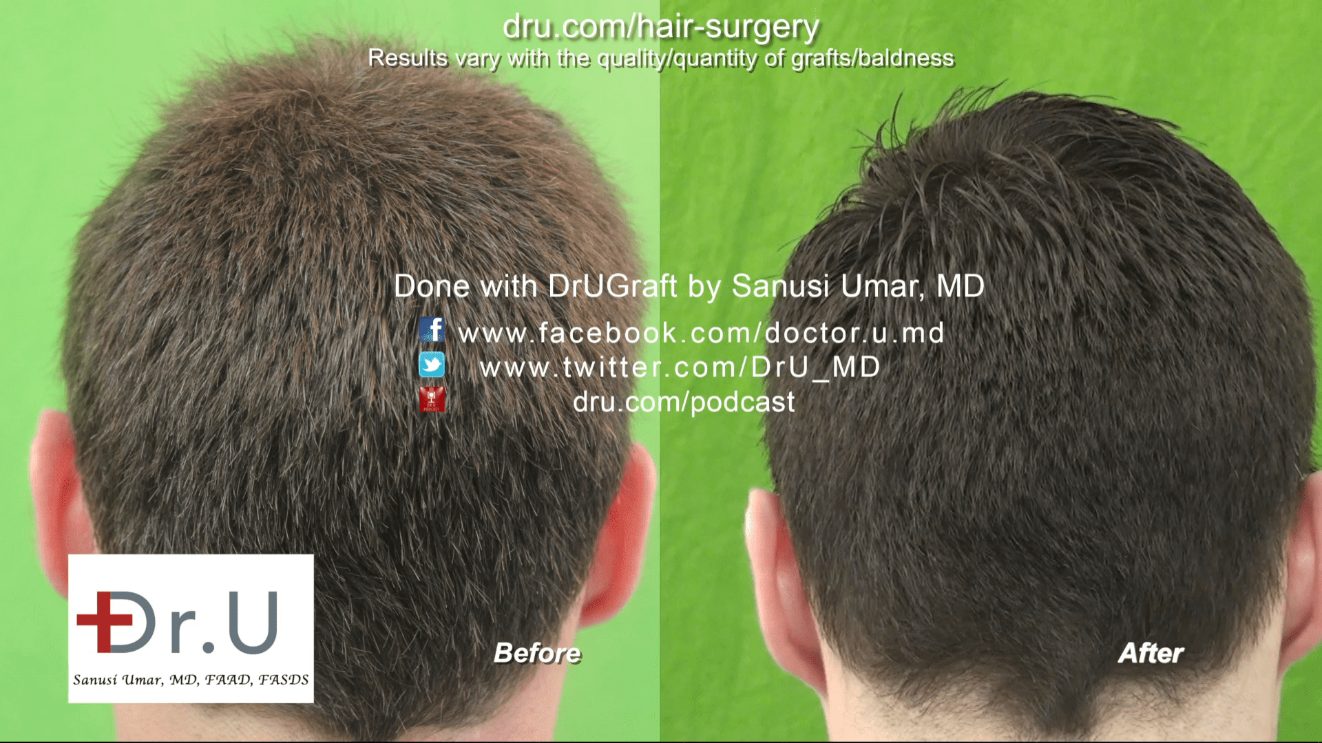 Video - Dr UGraft Forehead Size Reduction Hair Transplantation