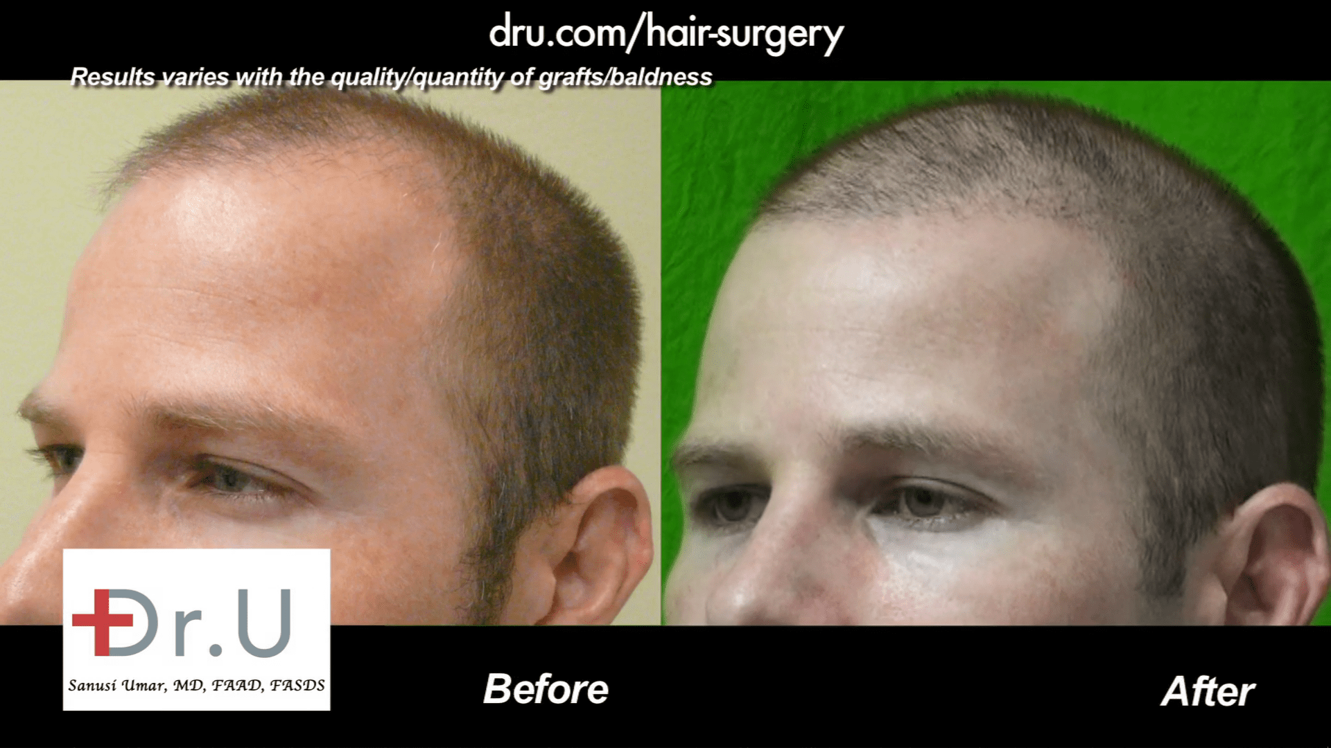 Video - The Hair Transplantation Less is More Approach Using 