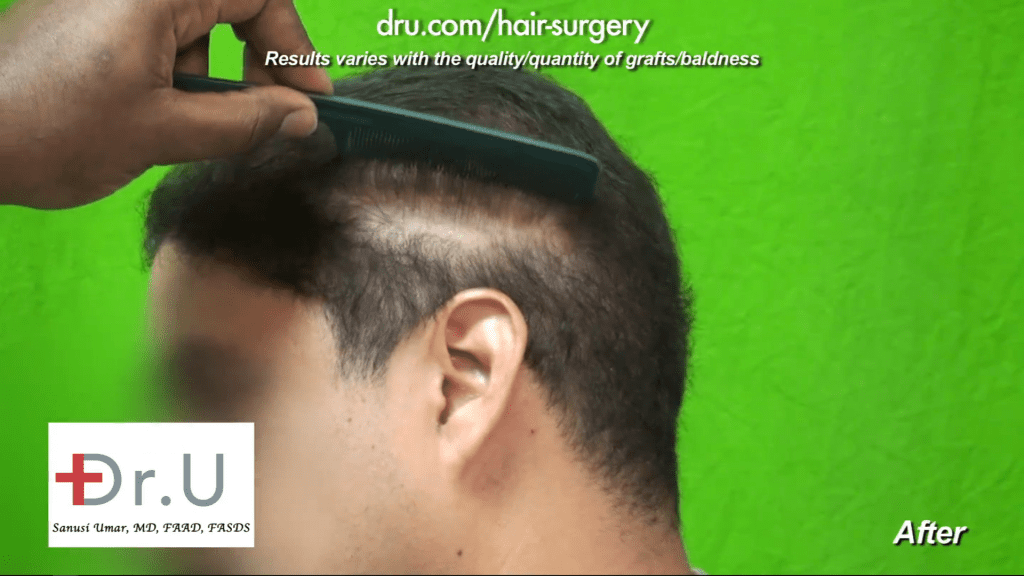 Shock Loss after Strip Surgery Scars: After the DrUGraft
