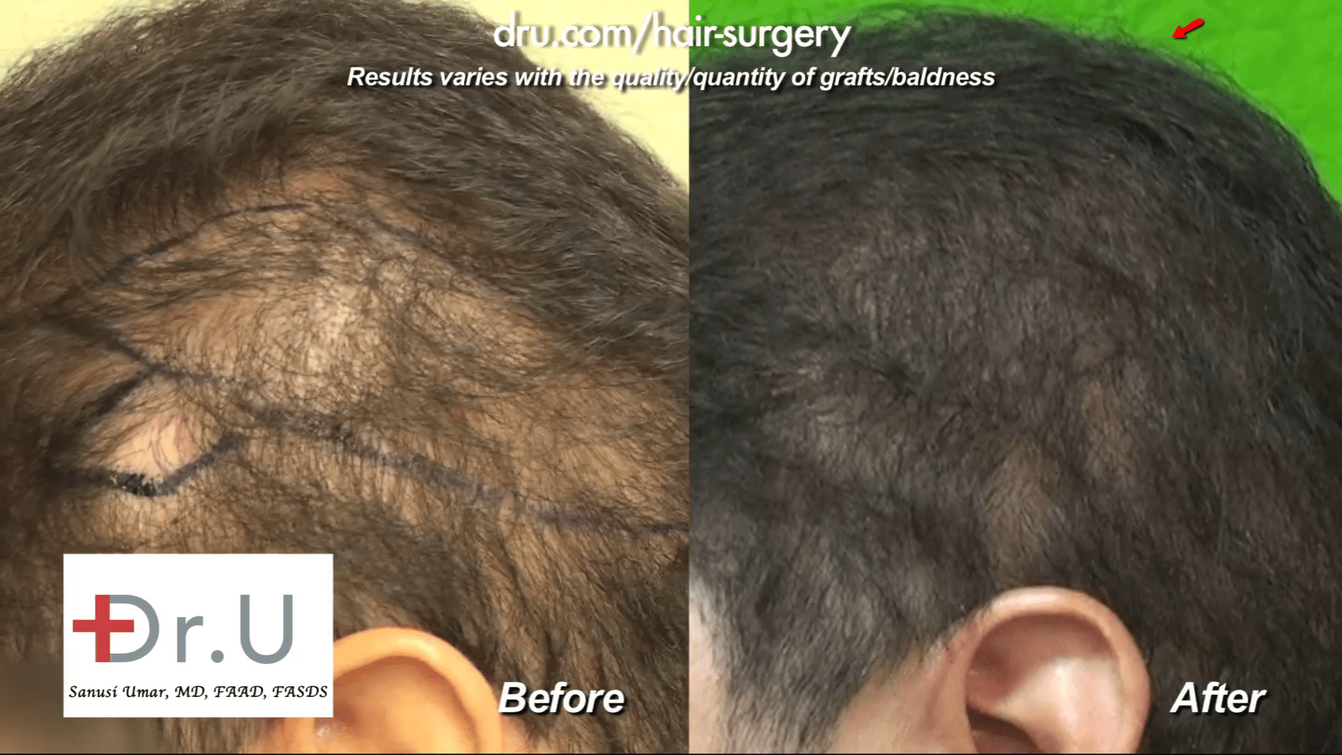Video - Hair Transplant Using Beard Hair in Los Angeles