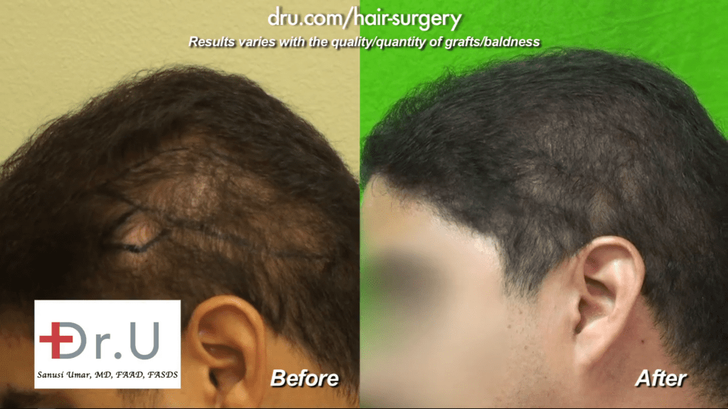 Shock loss in donor area after fut strip surgery repair before and after photos