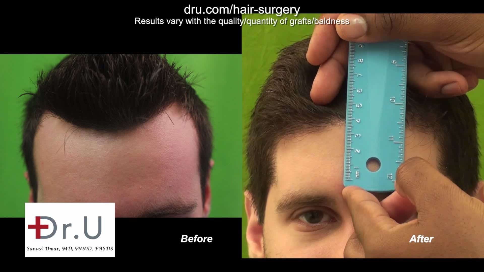 VIDEO: Forehead Reduction Using Hair Transplant with  FUE