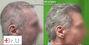 Before and After advanced FUE hair repair surgery