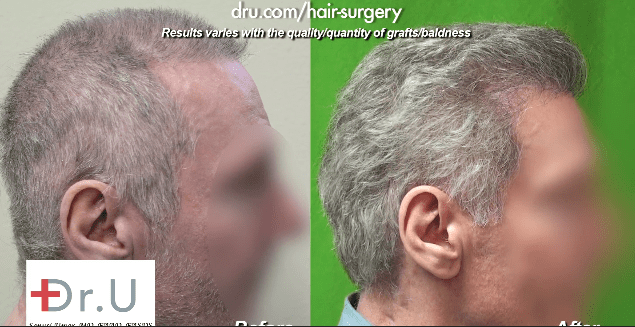 Who Weve Helped  Patient 1  FUE Hair Transplant London
