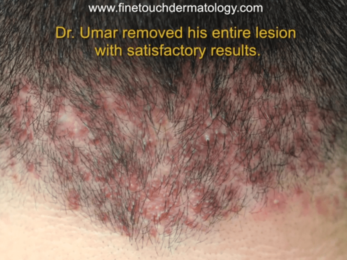 inflamed hair follicle on shaft