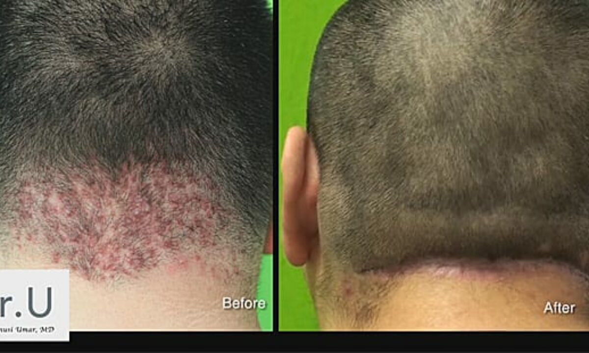 Acne Keloidalis Nuchae Patient Results - Dr. U Hair & Skin Clinic | FUE Hair  Restoration, Dermatology and Laser Surgery | Los Angeles, Manhattan Beach |  Dr Sanusi Umar MD